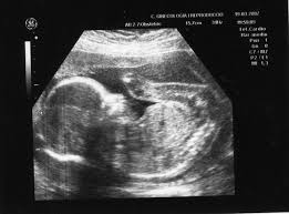 Come leggere un'ecografia ostetrica | Mamma e Bambino