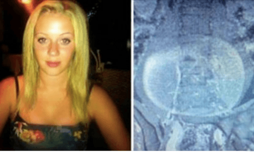 Olivia Key, nella pancia un tumore di 10 kg