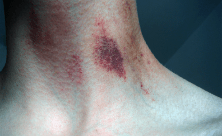 succhiotto sul collo websource